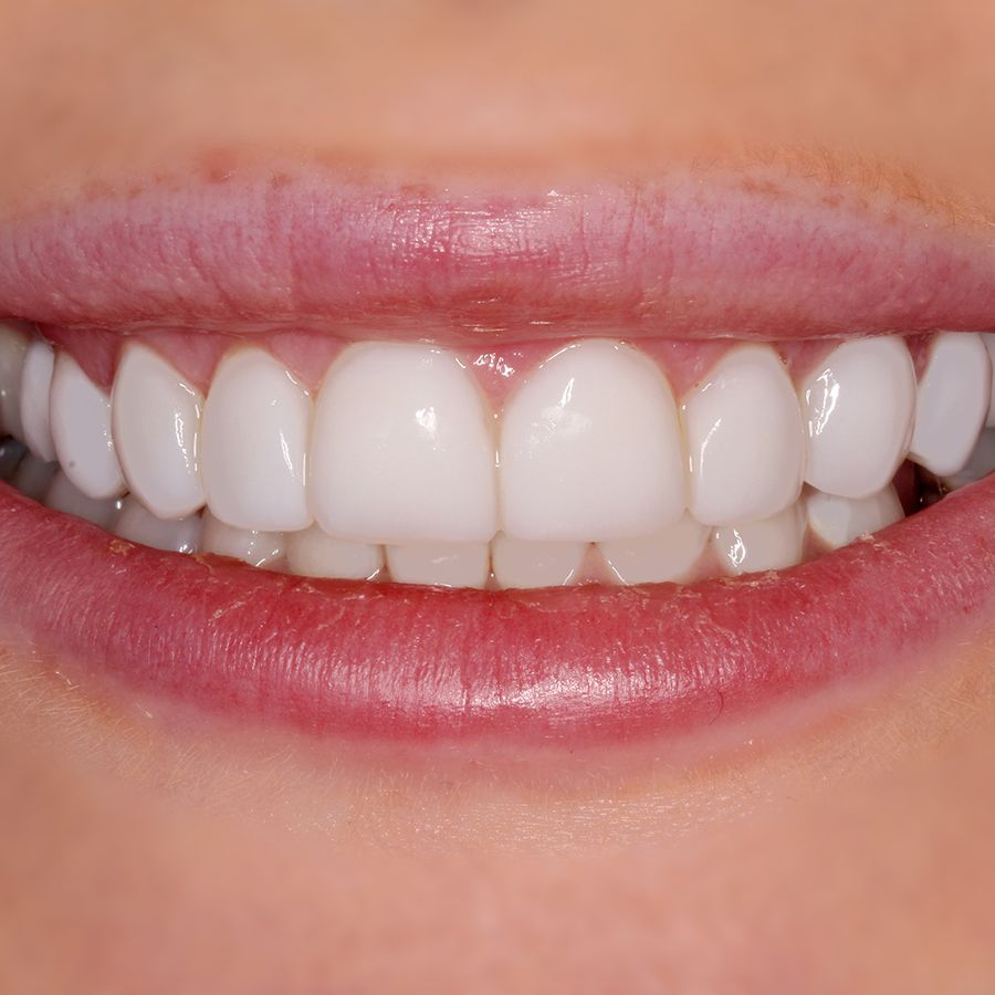 gum surgery - gum disease - after - 3Dental